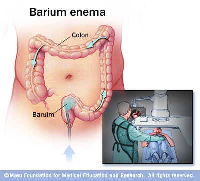 phonetic q es Barium   Drugs.com enema